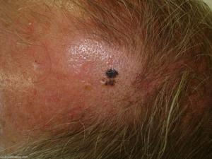 Melanoma, i segnali nascosti tra cuoio capelluto e unghie